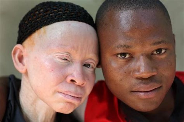 Are albinos considered disabled?