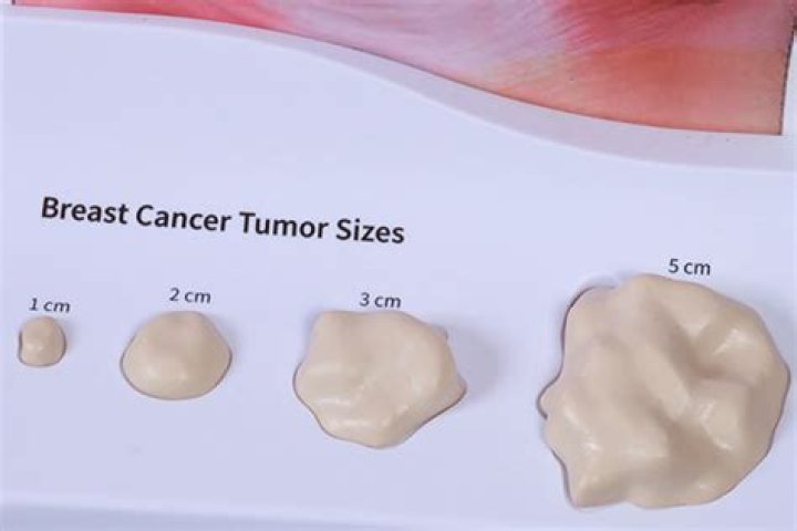 Are cancerous lumps movable or fixed?