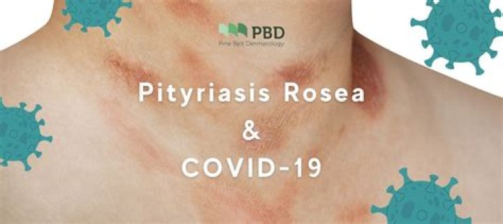 Are COVID-19 and Pityriasis rosea linked?