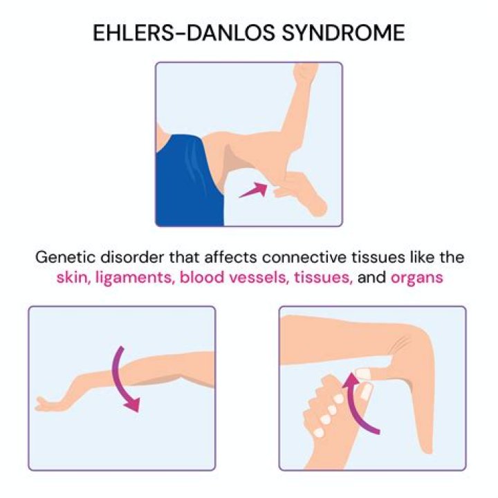 At what age is Ehlers-Danlos syndrome diagnosed?