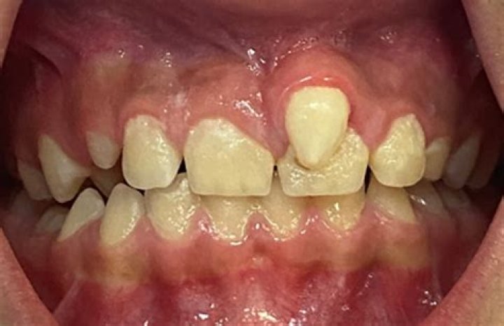 Can a baby have an extra tooth?