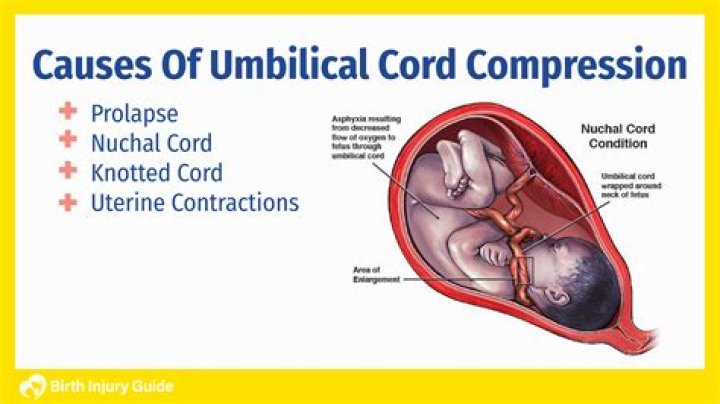 Can a child be born without an umbilical cord?