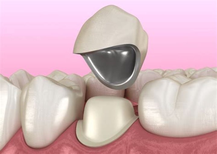 Can a dentist see a cavity under a crown?