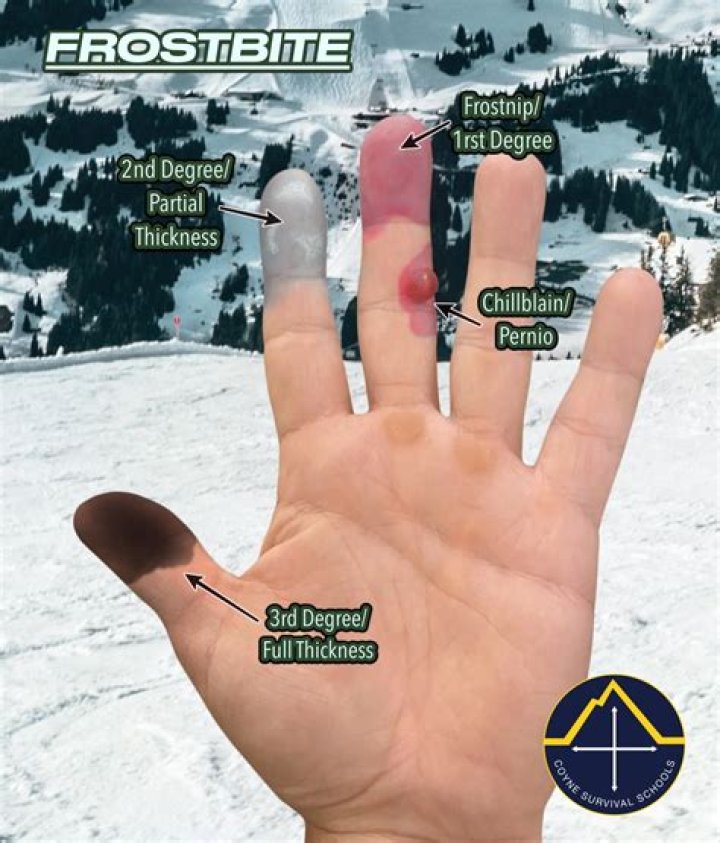 Can a horse bite off your finger?