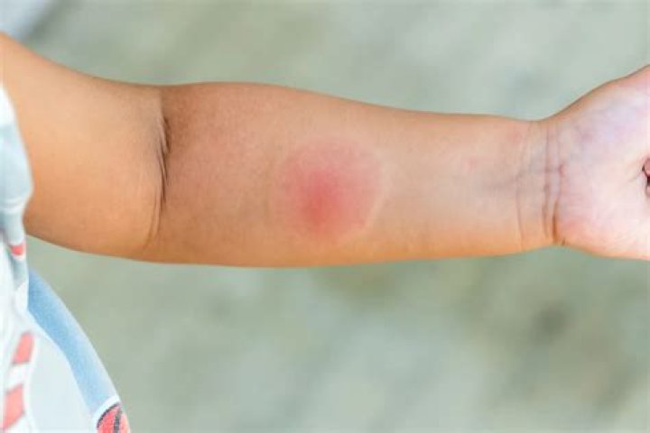 Can a insect bite cause sepsis?