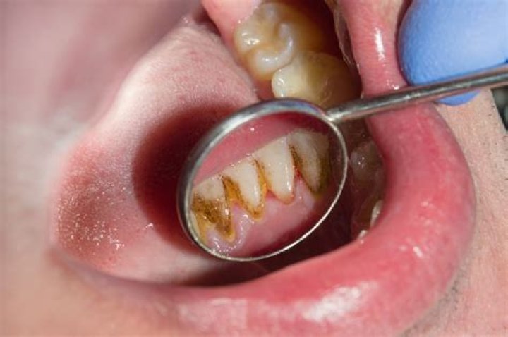 Can a rotten tooth be saved?