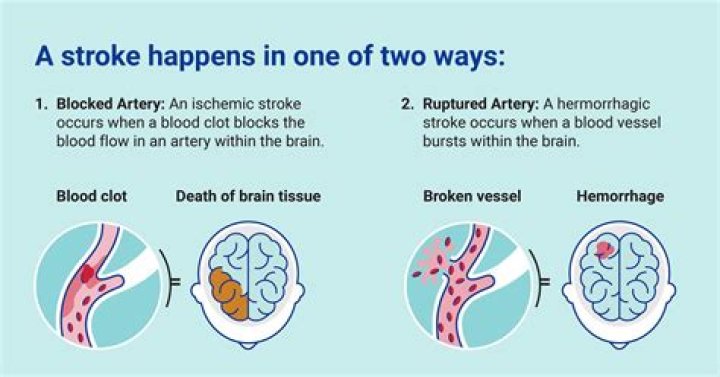 Can a stroke cause loss of empathy?