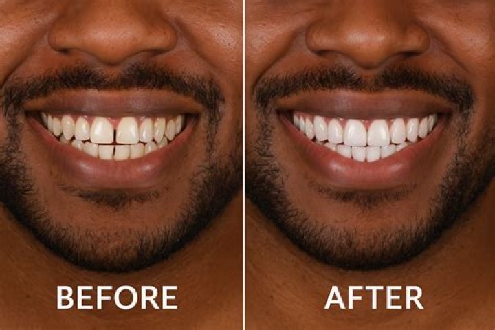 Can a veneer be glued back on?