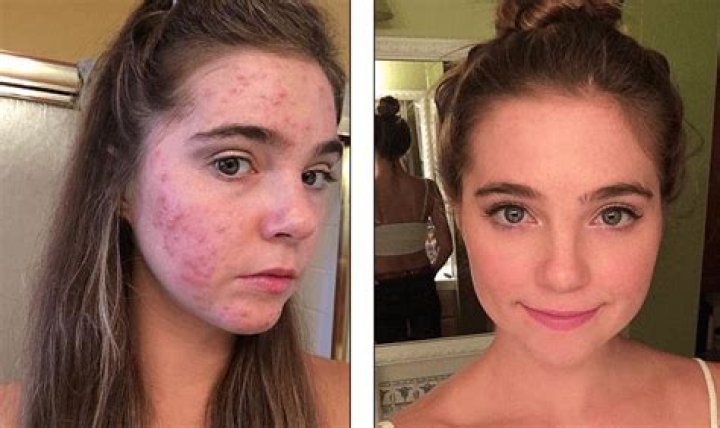 Can acne be cured?