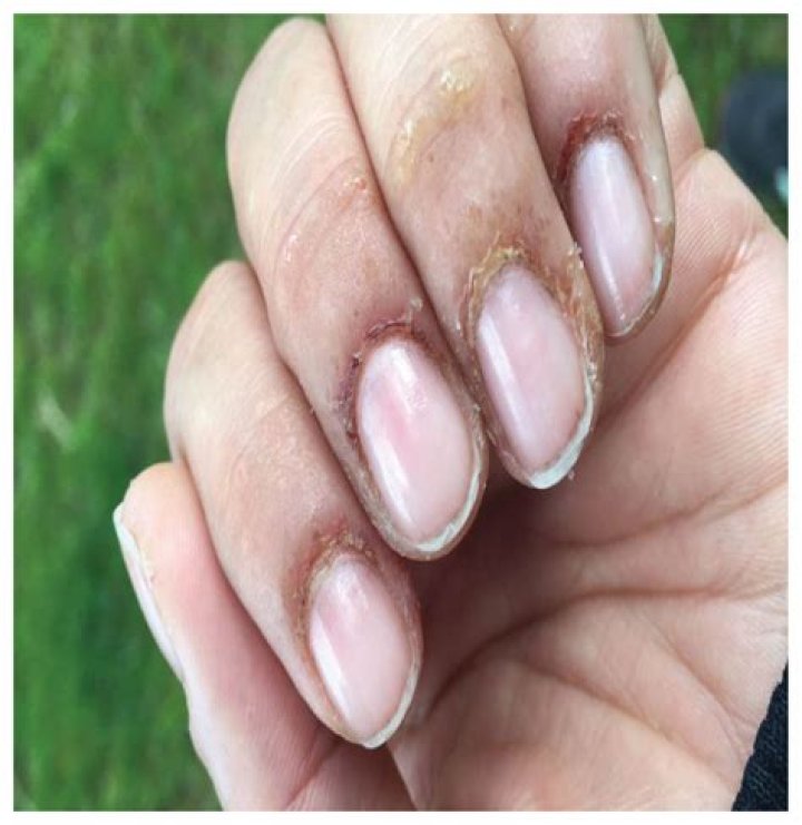 Can acrylic nails cause eczema?
