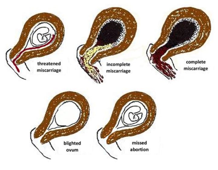 Can an Orgasim cause a miscarriage?