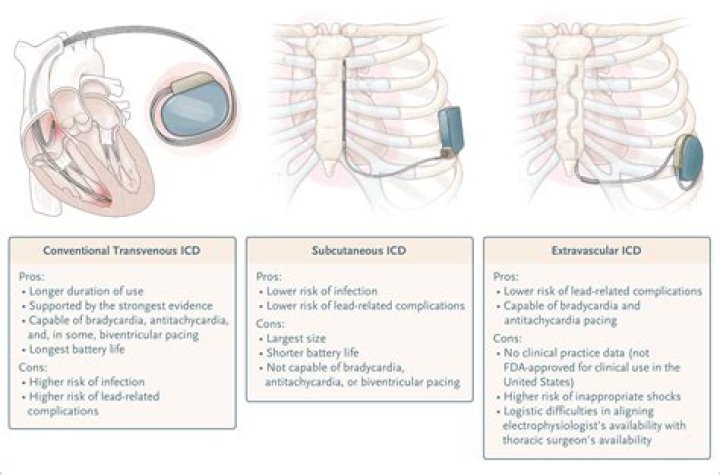 Can an S ICD pace the heart?