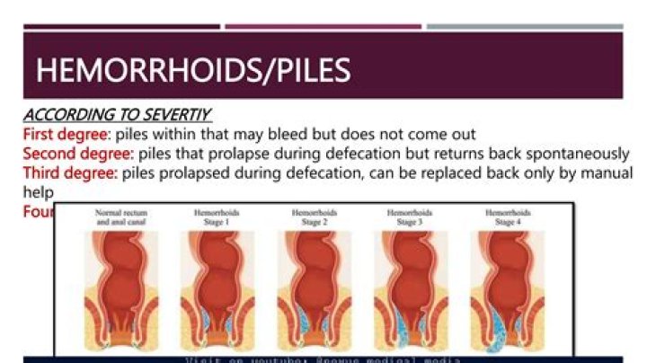 Can bidet cause hemorrhoids?