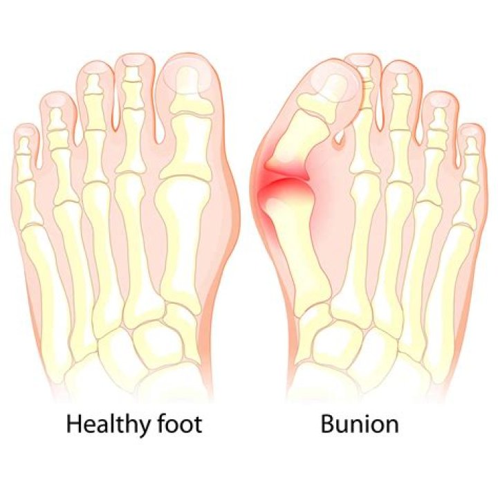 Can bunions cause fatigue?