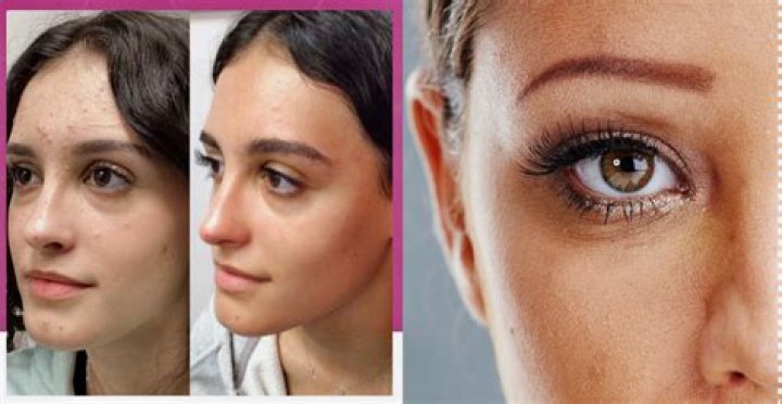 Can collagen cause facial hair?