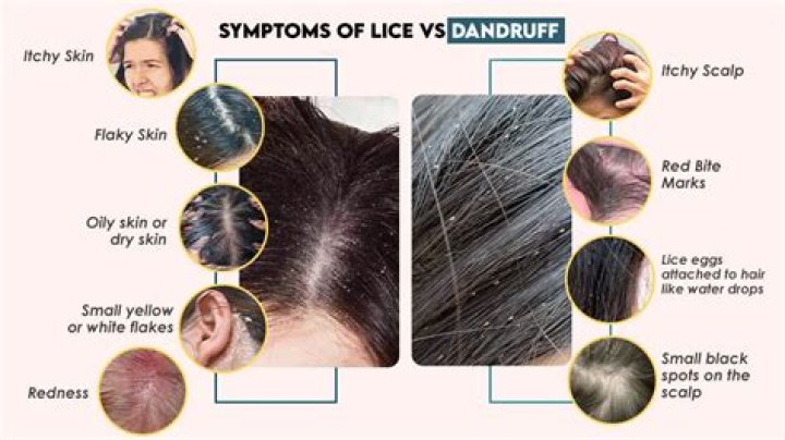 Can dandruff feel like lice?