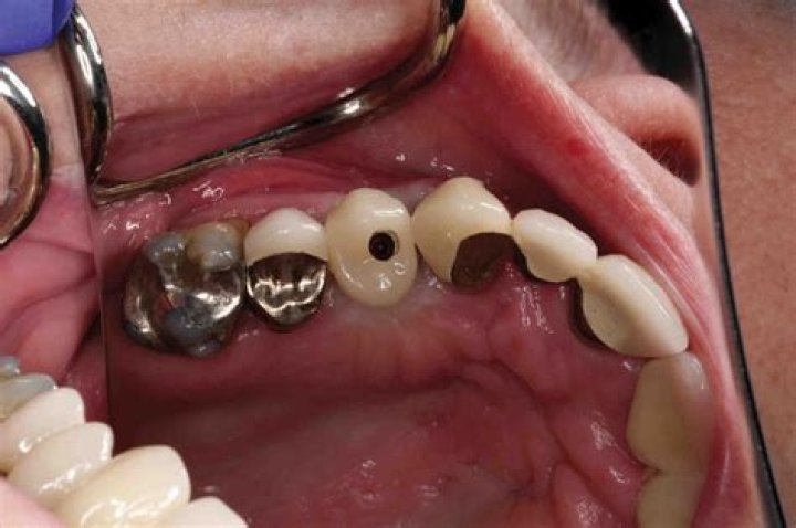 Can dry socket happen with stitches?