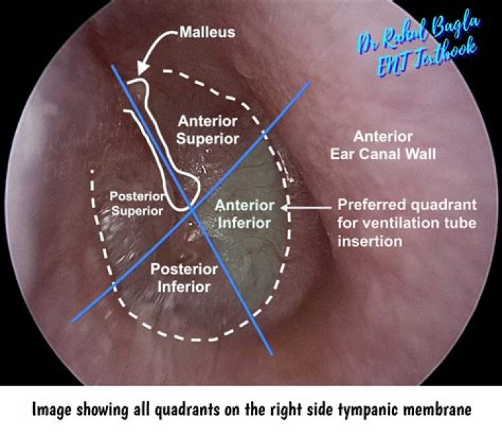Can eardrum be replaced?