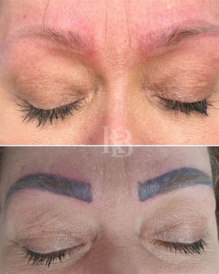 Can eyebrow tattoo be removed?