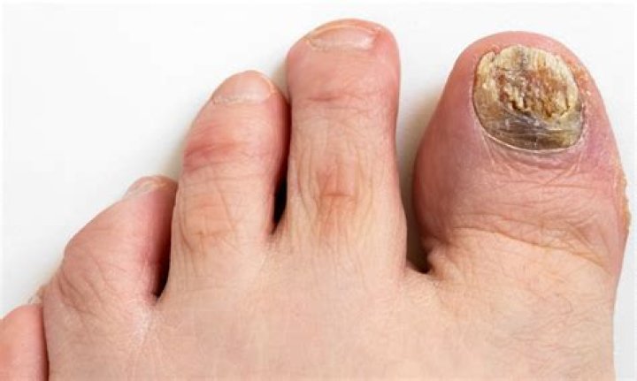 Can foot fungus spread to legs?