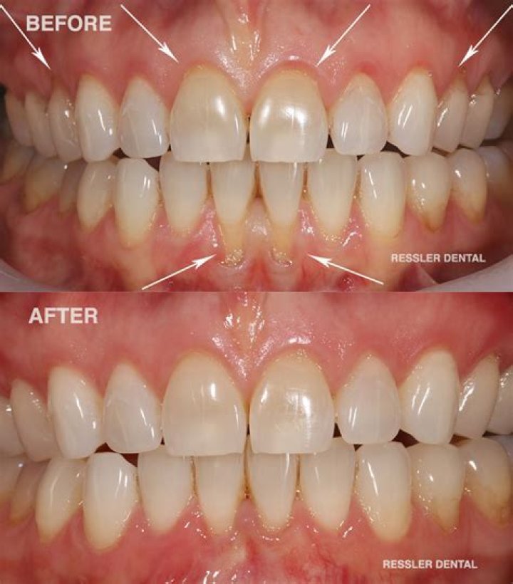 Can gums be restored?