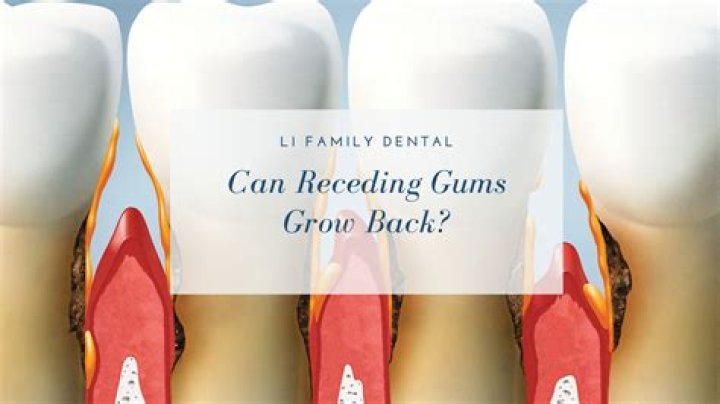 Can gums grow back up?