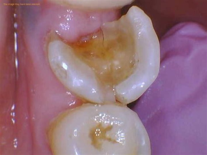 Can half a tooth be saved?