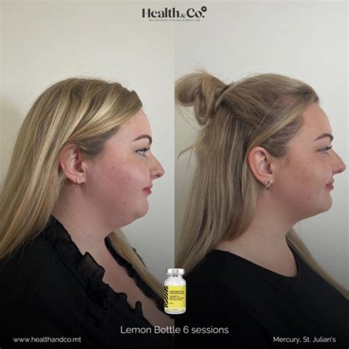 Can I apply lemon directly on face?
