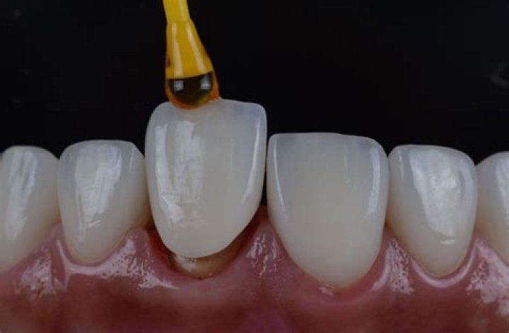 Can I brush my teeth after permanent crown?