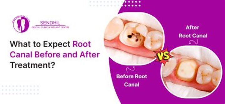 Can I brush my teeth after root canal with temporary filling?