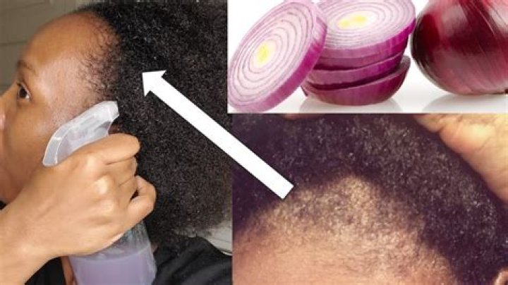 Can I directly apply onion juice on hair?