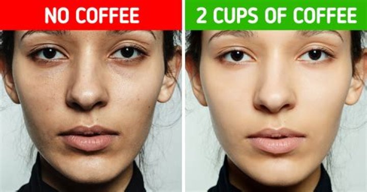 Can I drink coffee before gum graft?