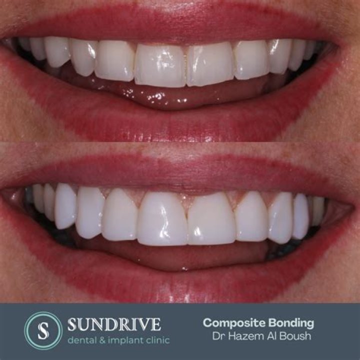 Can I drink red wine with composite bonding?