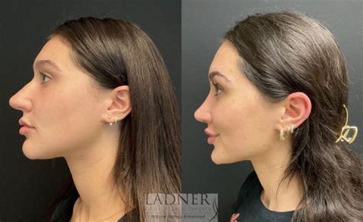 Can I get a nose job at 14 UK?