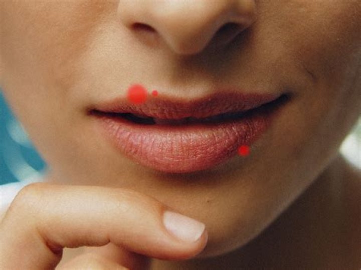 Can I get a pimple on my lip?