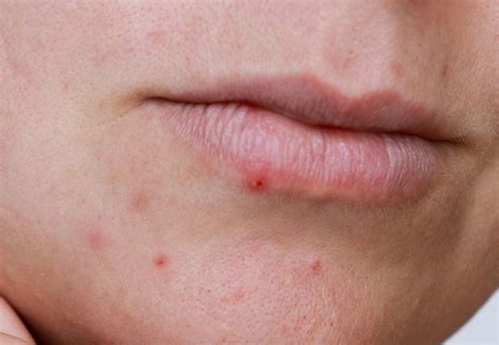 Can I get pimples on my lips?