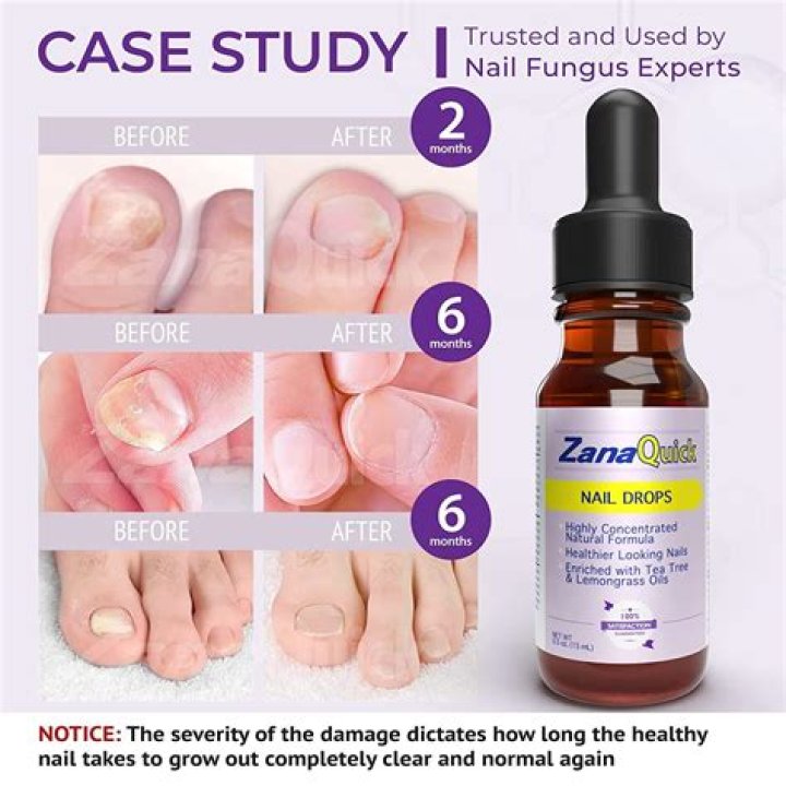 Can I wear nail polish while treating nail fungus?