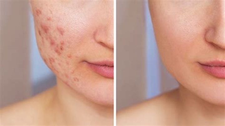 Can lemon clear acne?