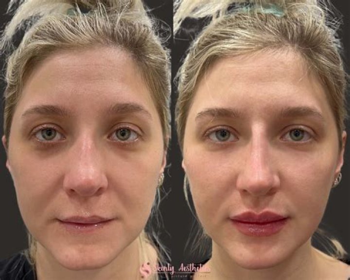 Can lip lift be done with fillers?