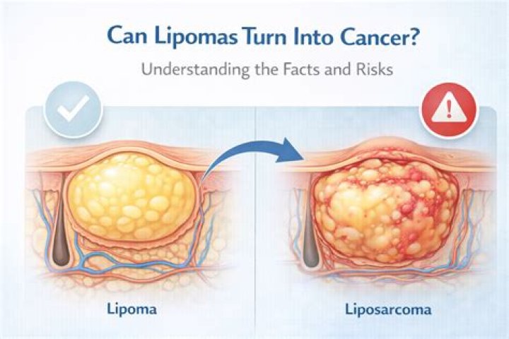 Can lipomas become cancerous?