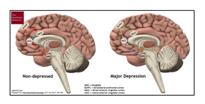 Can major depression turn into schizophrenia?