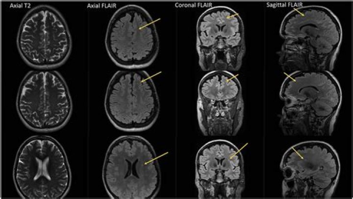 Can migraines cause white matter lesions?
