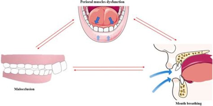 Can mouth breathing cause depression?