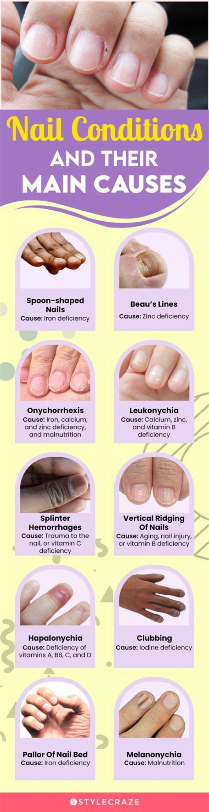 Can nails show heart problems?
