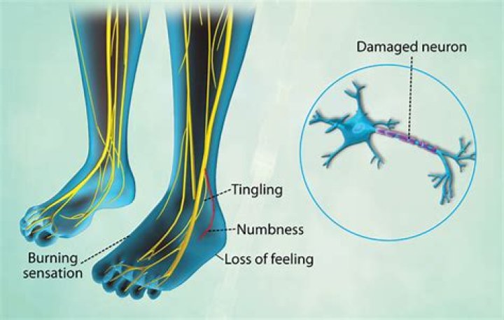 Can neuropathy heal on its own?