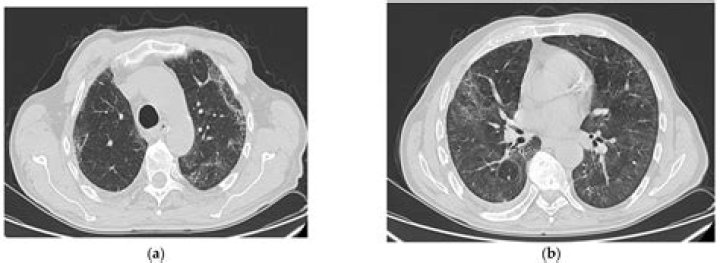 Can pulmonary fibrosis be misdiagnosed?