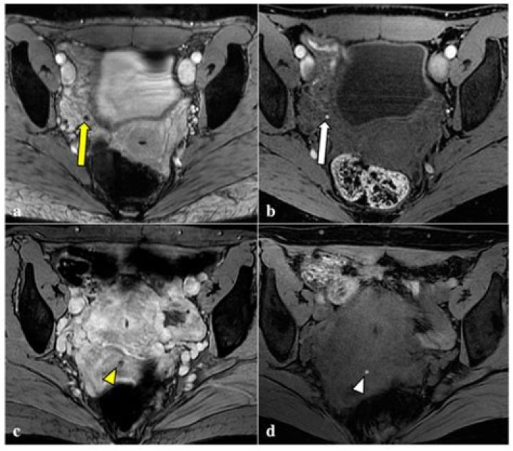 Can scar tissue show up on an MRI?