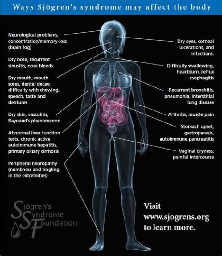 Can sjogrens affect your stomach?