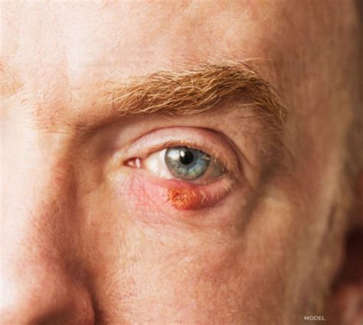 Can skin cancer affect your eyes?