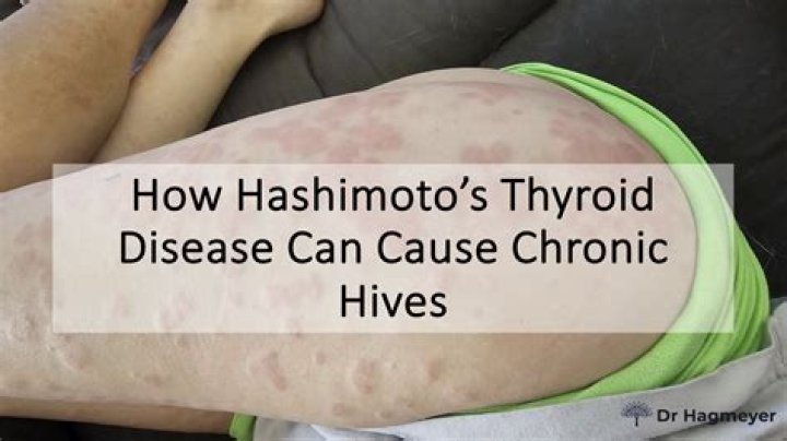 Can thyroid issues cause hives?